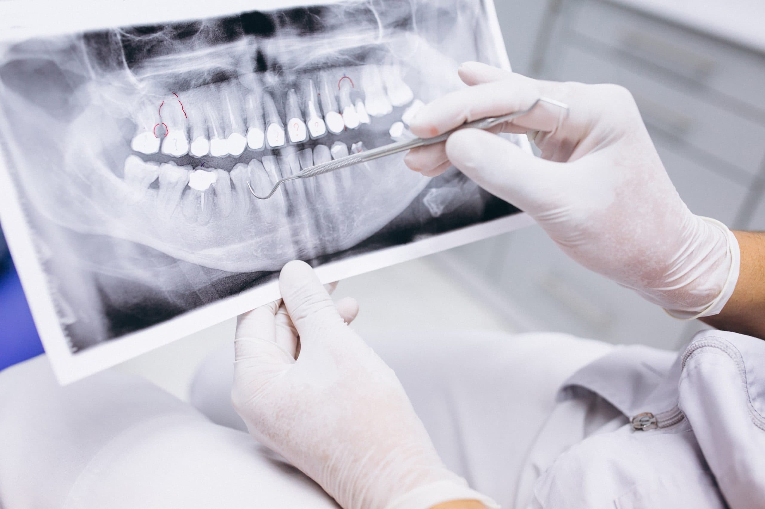 Radiografía utilizada para planificar una endodoncia