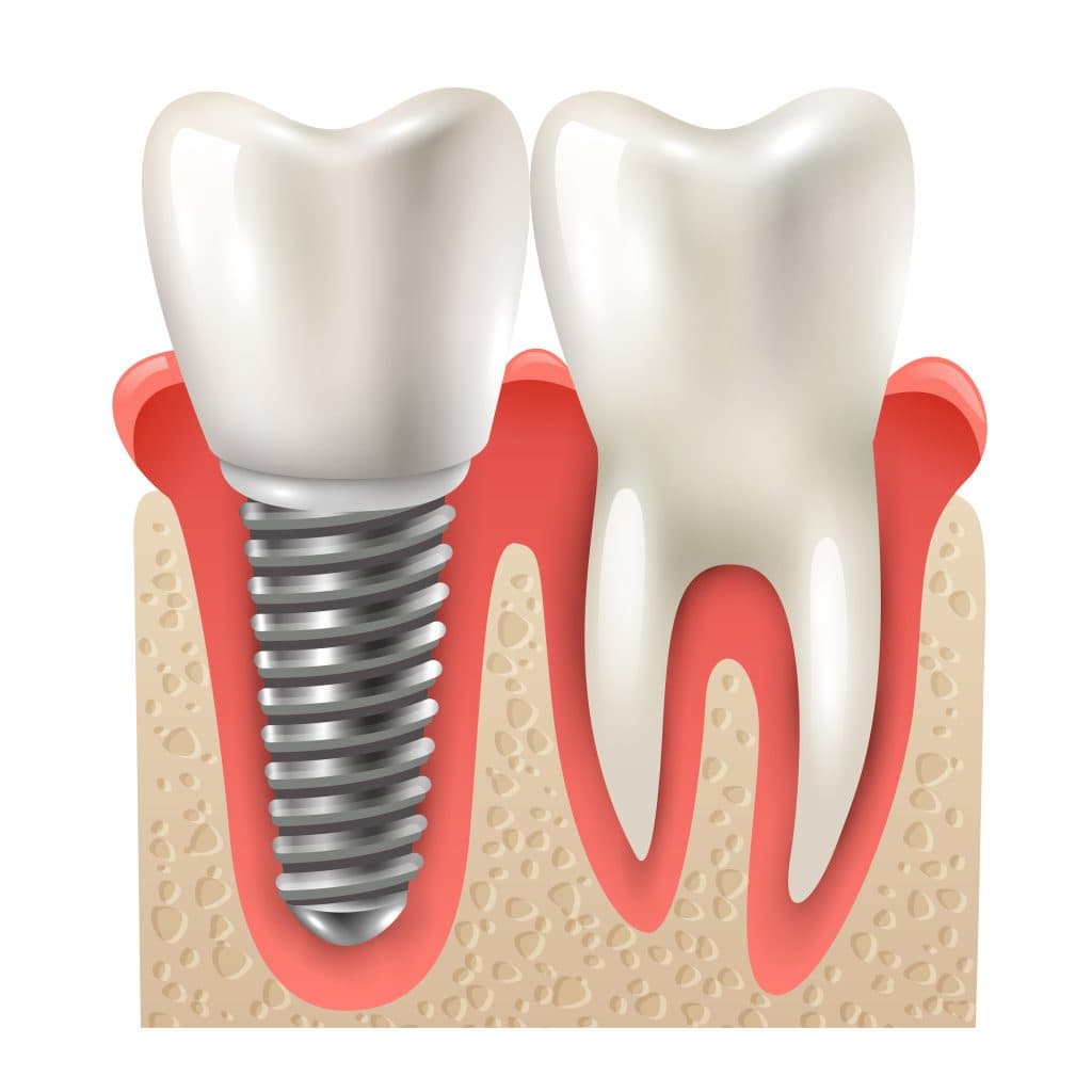 Modelo de una rehabilitación con implantes dentales